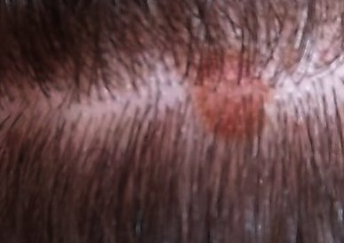 Causes of Painful Pimples on My Scalp