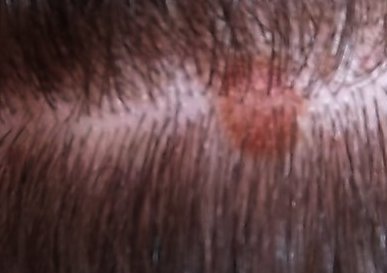 Causes Of Painful Pimples On My Scalp Iythealth Com   75 Scalp 