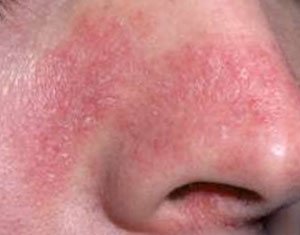 Dermatitis, also known as eczema