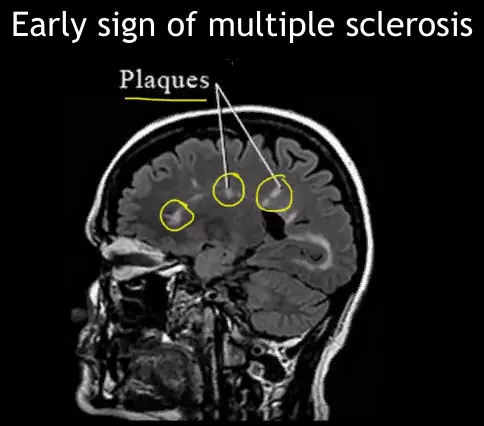 early sign of multiple sclerosis