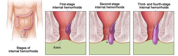 best sleeping position when you have hemorrhoids