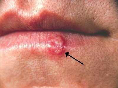 Bumps On Lips