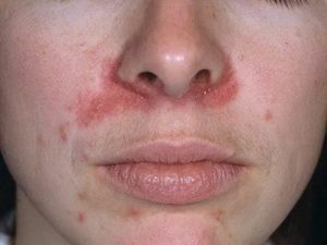 Perioral Dermatitis: Causes, Symptoms And Treatment - Health Advisor