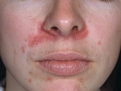 perioral dermatitis