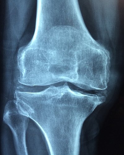 Osteoarthritis symptoms