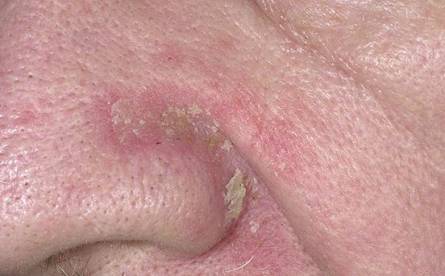 Dry flaky skin around nose