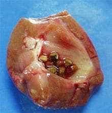 Kidney stone
