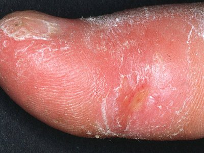 Systemic sclerosis finger