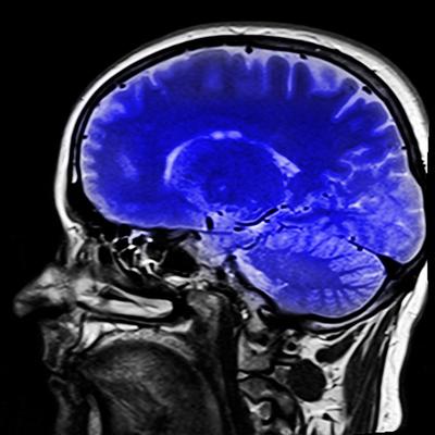 Magnetic resonance imaging for MS detection