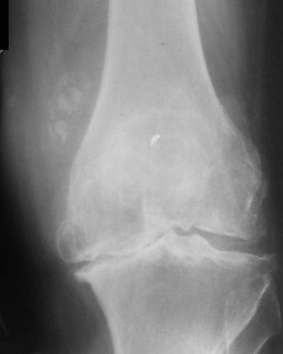 Osteoarthritis of the knee