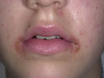 Perioral dermatitis on face