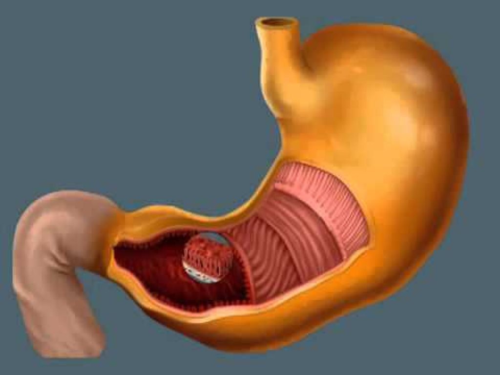 What is the Difference Between Heartburn, Acid Reflux and GERD Health