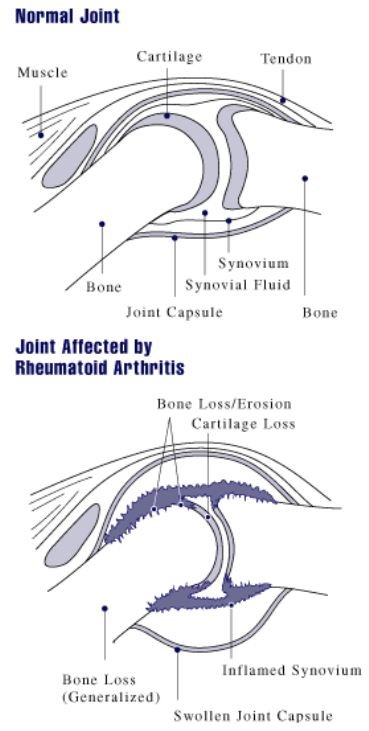 A diagram showing how rheumatoid arthritis affects a joint