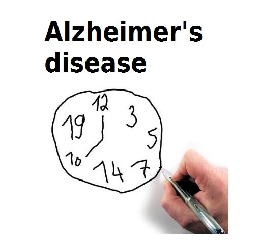 Alzheimer's disease and time