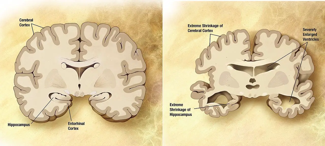 Alzheimer's disease brain comparison