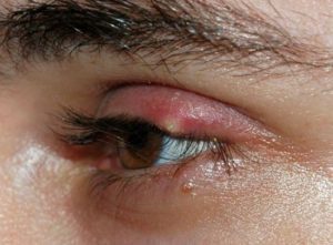 How To Know If You Have A Stye On Your Eyelid - Health Advisor