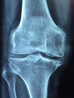 Knee. Inflammation of joint
