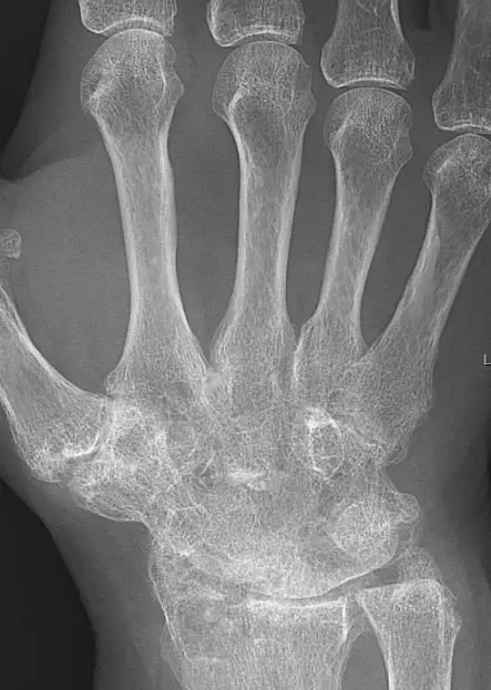 Rheumatoid arthritis with carpal ankylosis