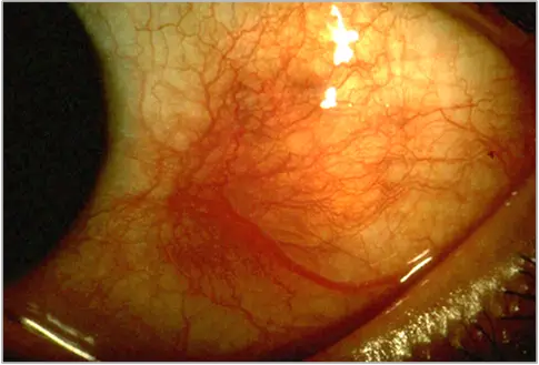 scleritis