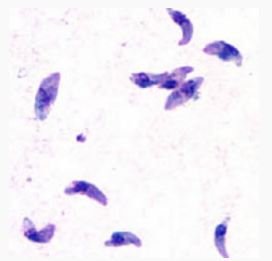 Toxoplasmosis