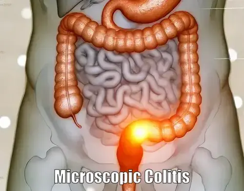 Microscopic Colitis