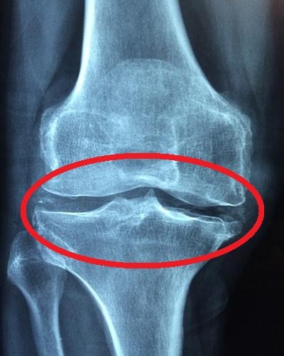 Knee joint