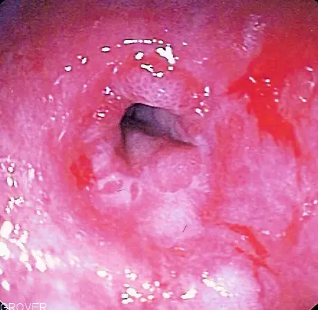 peptic stricture