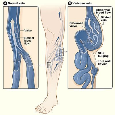 Varicose veins