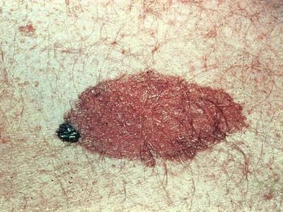 Congenital nevus from CDC