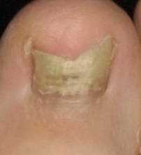 Nail fungus