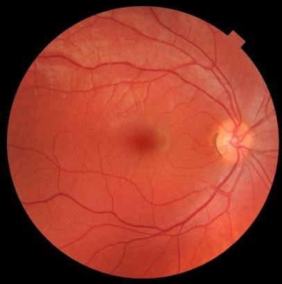 Fundus photograph of normal right eye