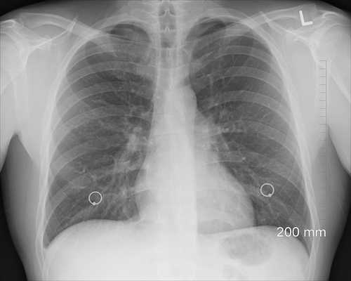 Photo of human lungs