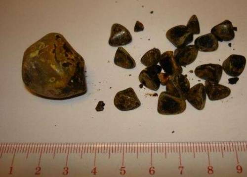 Gallstones and sizes