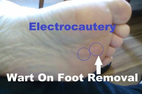 Wart on foot removal