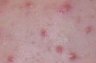 Pimple on skin