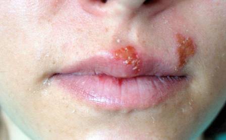 nose sores ulcers inside causes around polyps