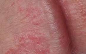 Penis Glans Rash