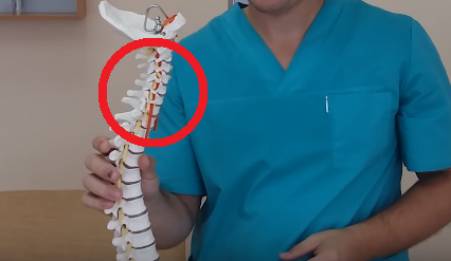 Loss of cervical lordosis