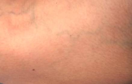 How to Get Rid of Spider Veins on Chest - Health Advisor