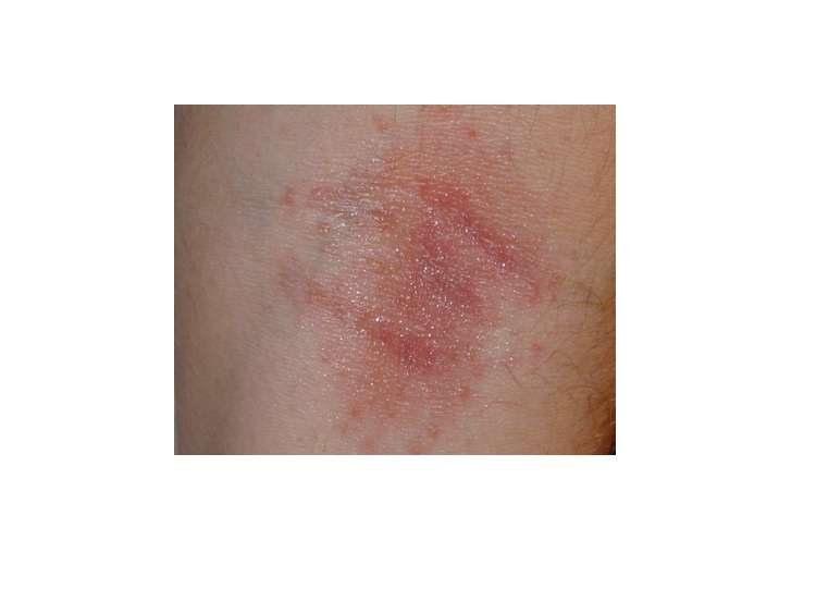 Asp sting symptoms