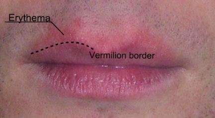 Erythema around the lips