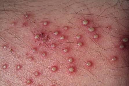 Folliculitis