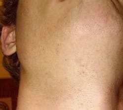 Pseudofolliculitis barbae