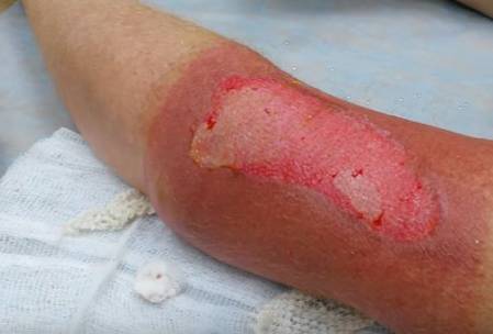 Scorch