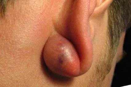 Sebaceous cysts