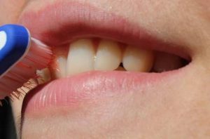 How much should teeth whitening cost