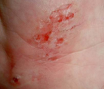 Abrasion on hand