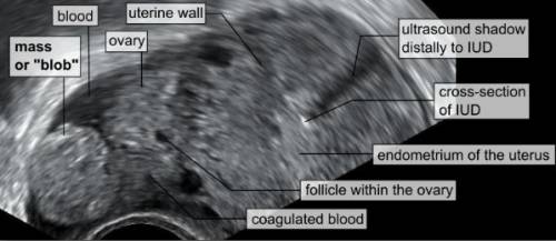 Blob sign of ectopic pregnancy