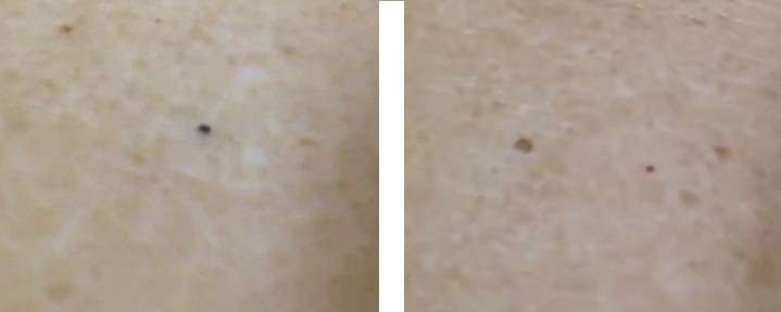 how-to-get-rid-of-blackheads-on-inner-thighs-health-advisor