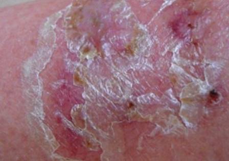 Eczema on your skin
